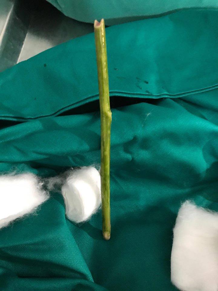 Đ&acirc;m que d&agrave;i hơn c&acirc;y b&uacute;t v&agrave;o tử cung ph&aacute; thai - Ảnh 1.