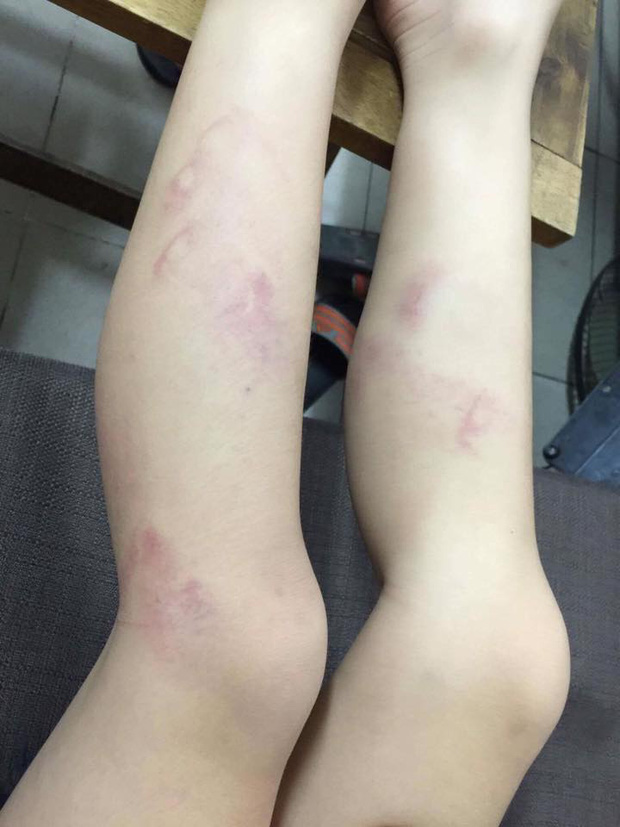 Cô giáo đánh học sinh tím chân ko hiểu sao lại làm vậy - Ảnh 1. Cô giáo đánh học sinh tím chân ko hiểu sao lại làm vậy - Ảnh 1.