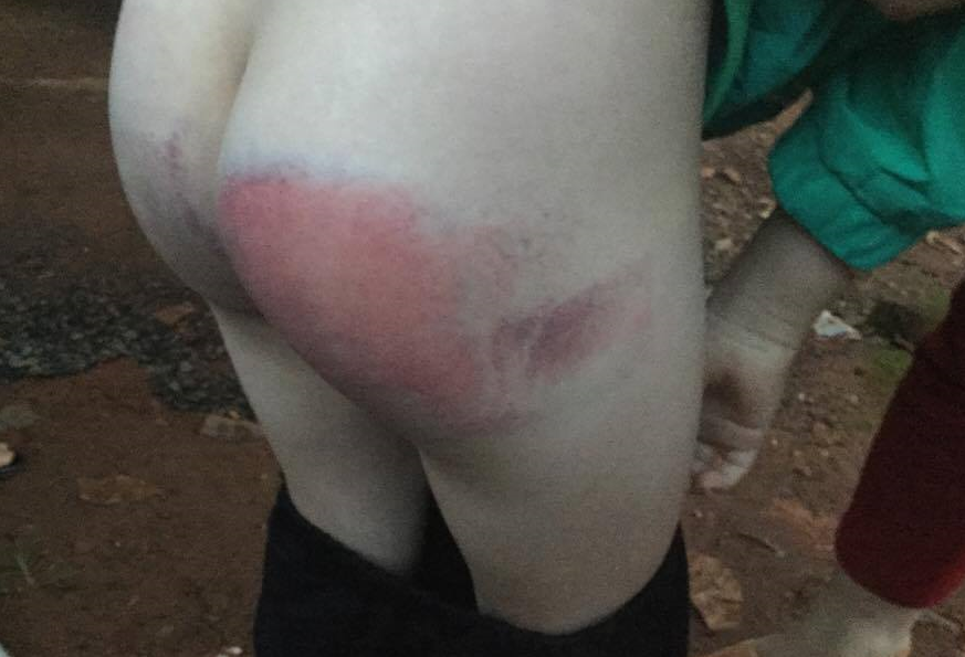 Bé gái 8 tuổi bị cô dạy Anh văn đánh bầm tím - Ảnh 1.