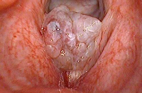 Nhiễm virus HPV, sinh viên 23 năm mang ống thông ngay cổ - Ảnh 1.