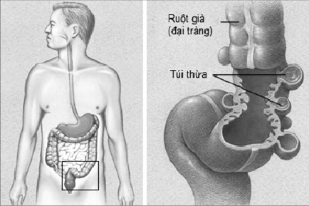 Tự điều trị đau bụng, người đàn ông suýt chết - Ảnh 2.