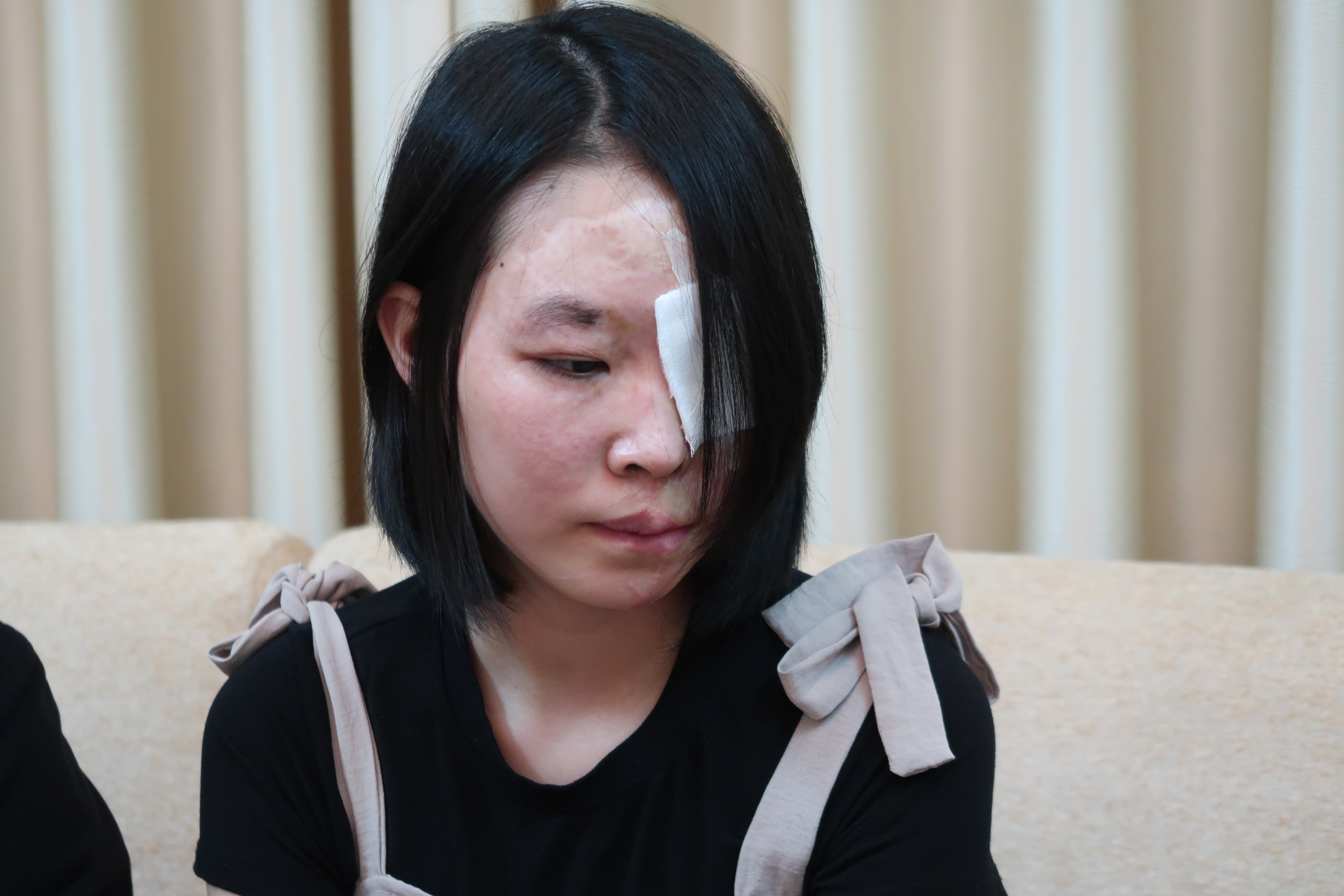 Nữ sinh bị tạt axit trần ai t&igrave;m sự tự tin - Ảnh 1.