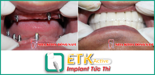 
Kết quả cấy ghép Implant ETK Active tại Nha Khoa Đông Nam
