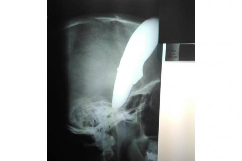 Bị dao đâm xuyên đầu, vẫn đạp xe đi tìm bác sĩ - Ảnh 2. Bị dao đâm xuyên đầu, vẫn đạp xe đi tìm bác sĩ - Ảnh 2.