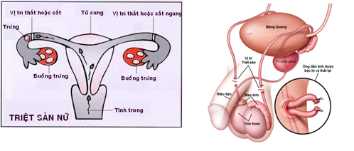 Triệt sản rồi bỗng có con trở lại - Ảnh 1.