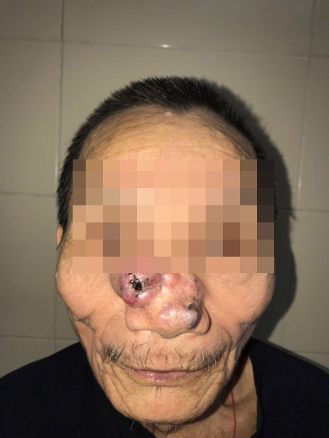 Một nam giới bị khoét sạch mũi, má vì ung thư da - Ảnh 1.