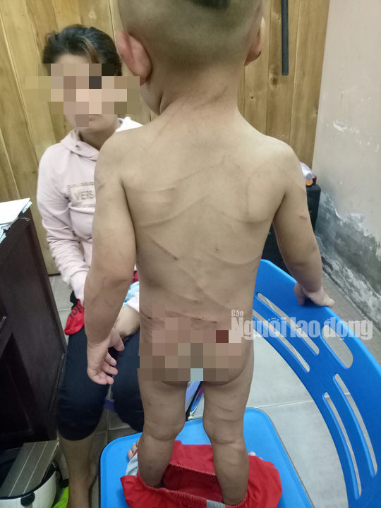 Giải cứu bé trai 3 tuổi bị cha dượng đánh dã man ở Phú Quốc - Ảnh 1.