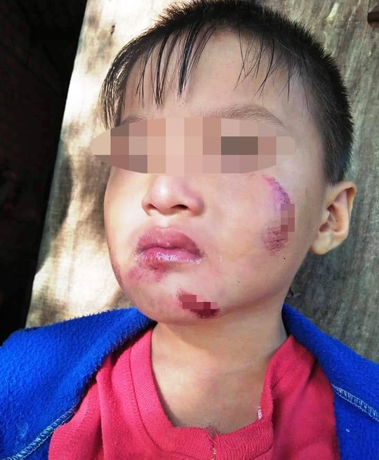Một cháu bé 6 tuổi nghi bị chính mẹ ruột đánh dã man - Ảnh 4.