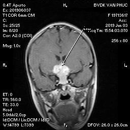 Kỳ lạ bé gái mắc chứng hay nhớ hay quên - Ảnh 1.