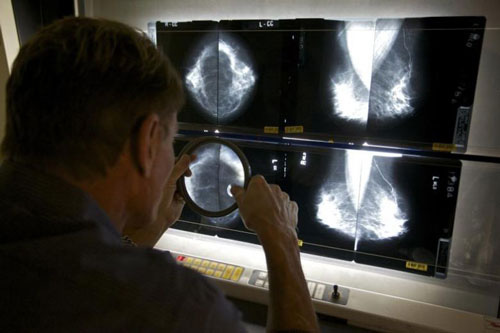 AI có thể giúp chẩn đoán ung thư vú chính xác hơn - Ảnh 1.