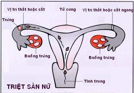 Triệt sản xong bỗng mất lửa chuyện ấy, vì sao? - Ảnh 1.