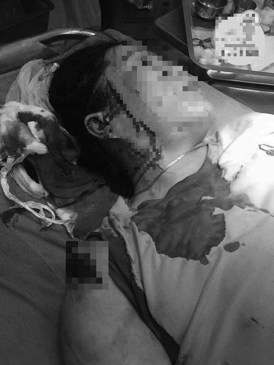 Bình Thuận: Hẹn đánh ghen, một phụ nữ bị đâm rách mặt  - Ảnh 1.