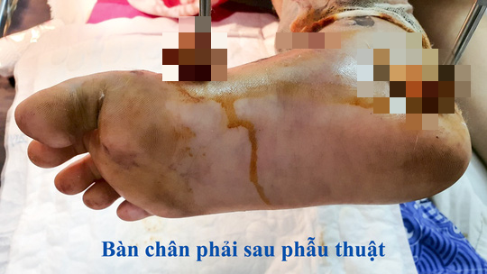 Căng thẳng cứu lấy bàn chân bệnh nhi bị dập gần nát do TNGT - Ảnh 2.