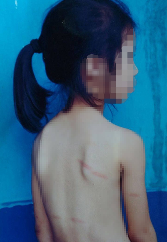 Cô giáo đánh nữ sinh lớp 1 tím người vì không làm được Toán - Ảnh 2.