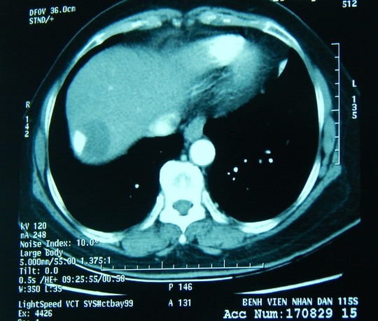 Loại bỏ khối u gan khổng lồ ở bệnh nhân nữ 67 tuổi - Ảnh 1.