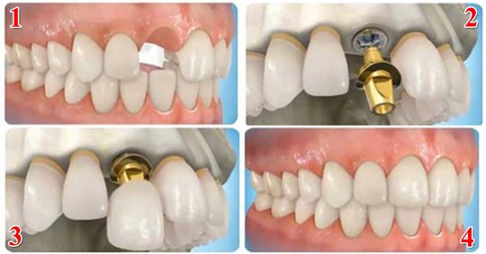 Tái tạo răng thật bằng công nghệ cắm ghép Implant - Ảnh 1.