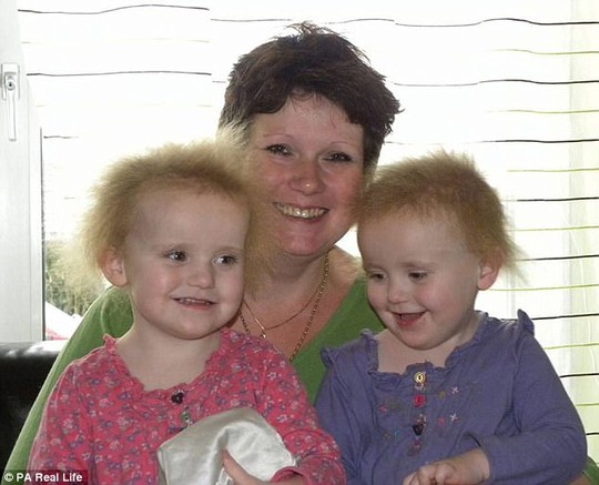 Hai cô bé song sinh bị hội chứng tóc xù - Ảnh 5.