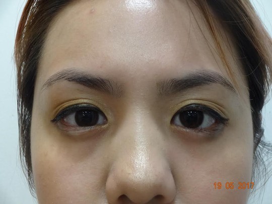 Đến Việt Nam, cô gái Mỹ cứu được con mắt bị bệnh hiếm gặp - Ảnh 2.