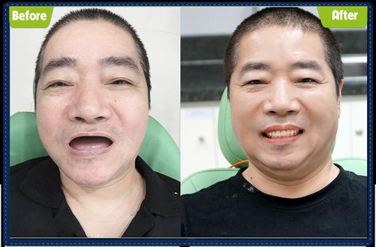 Bếp trưởng Đài Loan vượt ngàn dặm đến Việt Nam để làm răng  - Ảnh 3.