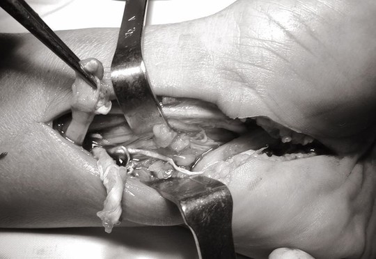 Cổ tay bầy nhầy vì chích corticoid trị hội chứng ống cổ tay - Ảnh 2.