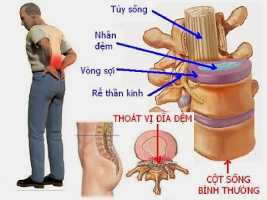 7 dấu hiệu thoát vị đĩa đệm lưng đặc trưng nhất định phải nhớ - Ảnh 1.