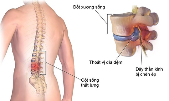 7 dấu hiệu thoát vị đĩa đệm lưng đặc trưng nhất định phải nhớ - Ảnh 3.