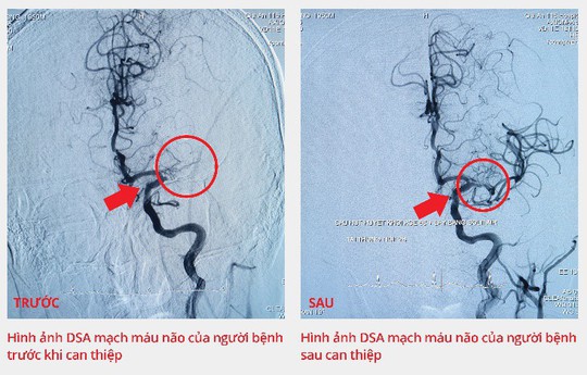 Bệnh viện Gia An 115 kịp thời cứu bệnh nhân bị tắc động mạch não - Ảnh 2.