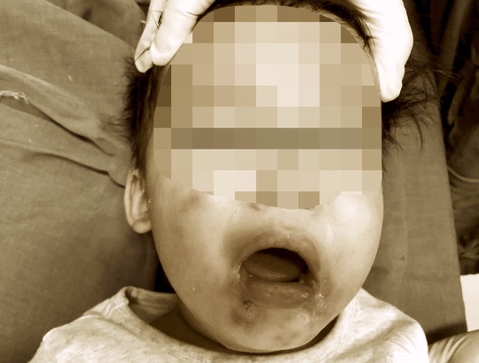 Cắn dây điện trong lúc chơi, bé gái 2 tuổi bị bỏng nặng do điện giật - Ảnh 2.