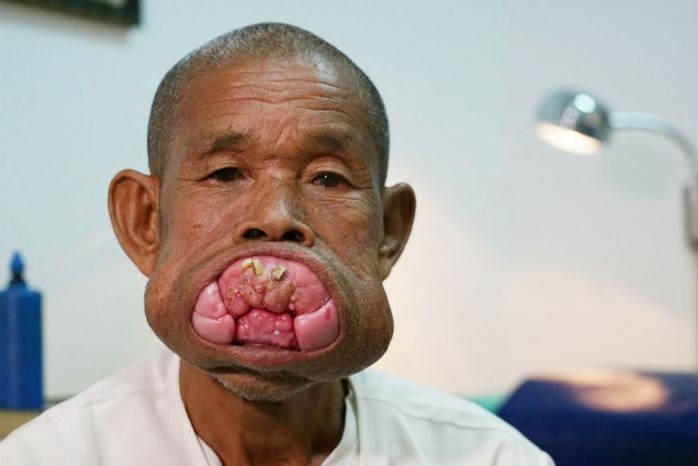 Cụ ông Campuchia sau ca phẫu thuật bộ nướu răng khổng lồ - Ảnh 1.