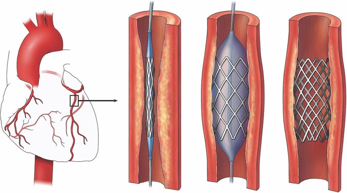 Stent thế hệ mới cho bệnh nhân mạch vành - Ảnh 1.