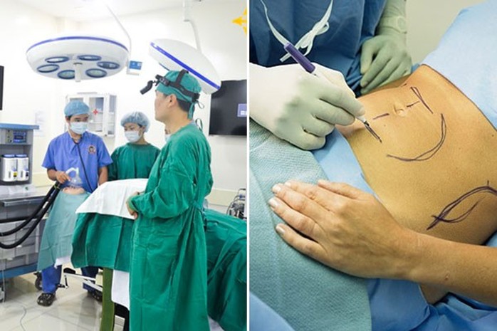 Kinh hoàng những biến chứng nguy hiểm của việc hút mỡ bụng - Ảnh 3.