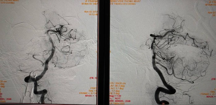 Lôi được cục máu đông gây đột quỵ dài nhất Việt Nam - Ảnh 2.