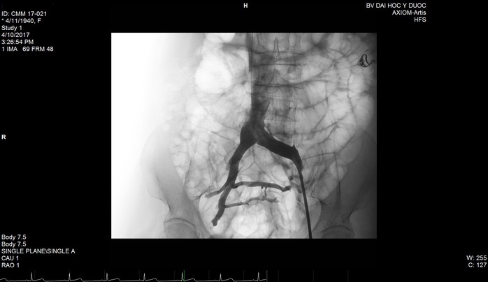 
Và mạch máu đã lưu thông lại nhiều sau khi được đặt stent.
