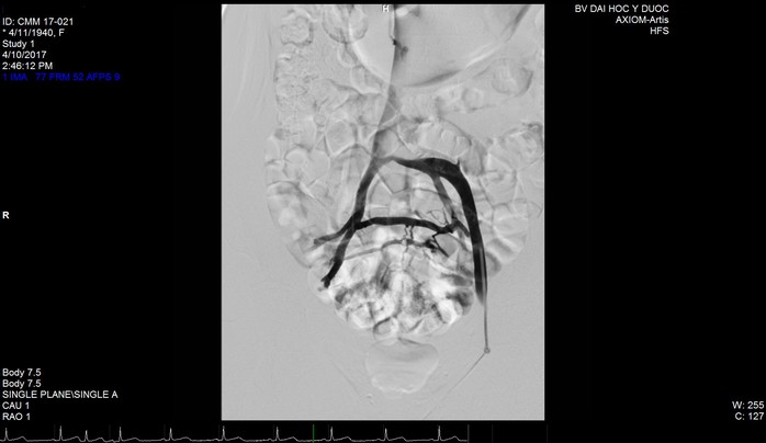 
Tĩnh mạch người bệnh bị tắc trứơc khi đặt stent.
