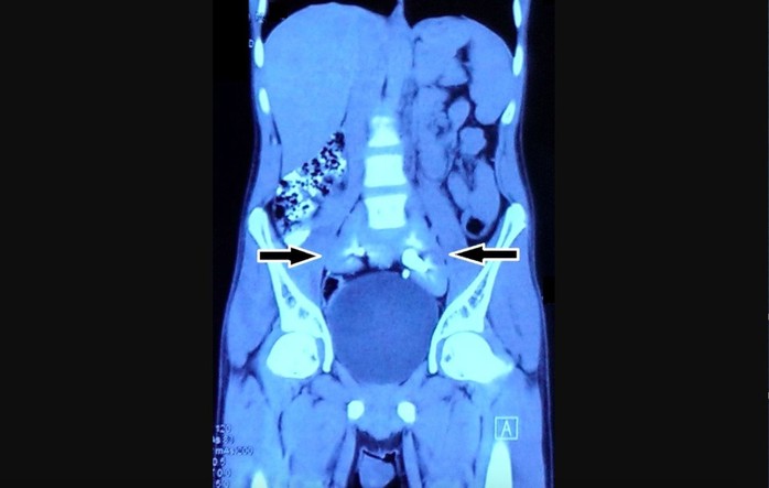 Chụp phim thấy 2 quả thận biến mất, chỉ còn 1… chiếc đĩa! - Ảnh 1.
