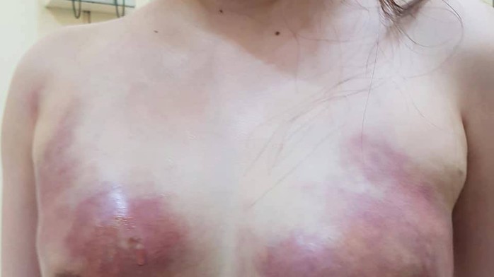 Cô gái trẻ bị hoại tử ngực vì bơm mỡ nhân tạo ở Spa - Ảnh 1.