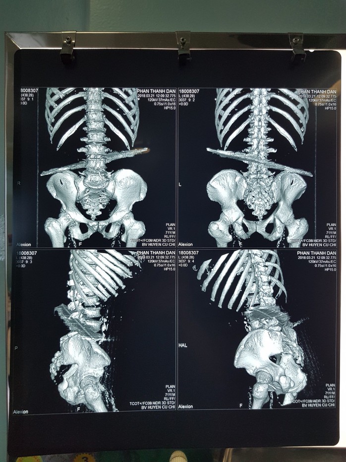 Trượt ngã, cụ ông bị  cọc sắt đâm xuyên hông - Ảnh 2.