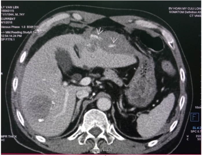 Xuất viện sau 36 giờ điều trị vỡ u gan bằng phương pháp TACE - Ảnh 1.