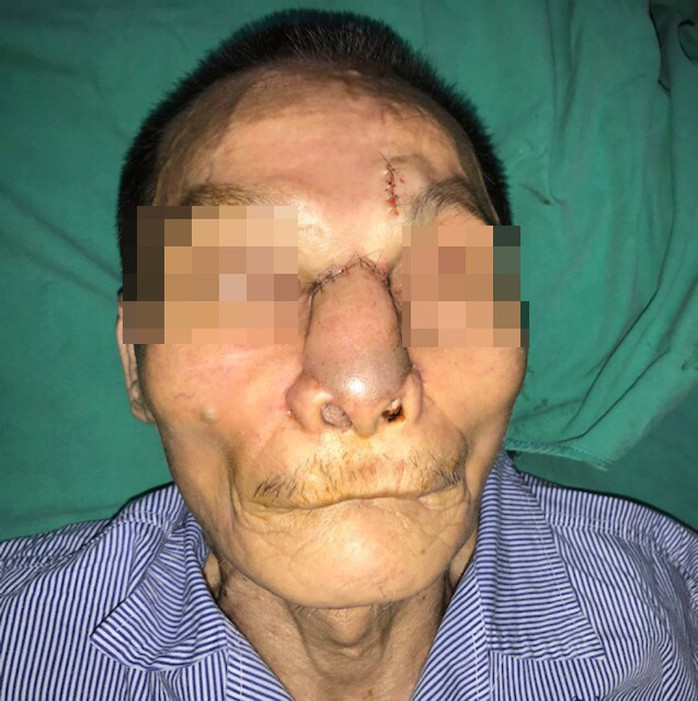 Một nam giới bị khoét sạch mũi, má vì ung thư da - Ảnh 2.