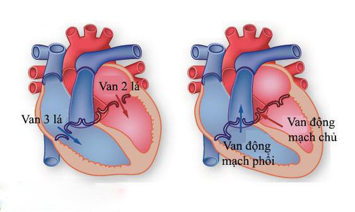Hở van tim đã khổ, đừng để tiến triển thành suy tim còn khổ hơn - Ảnh 2. Hở van tim đã khổ, đừng để tiến triển thành suy tim còn khổ hơn - Ảnh 2.