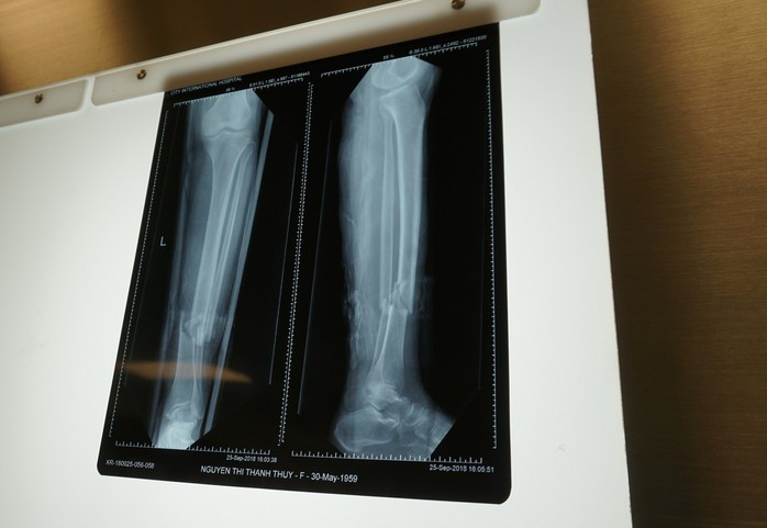 Yêu cầu kỳ lạ, người phụ nữ gãy chân bị nhiều bệnh viện từ chối - Ảnh 1.