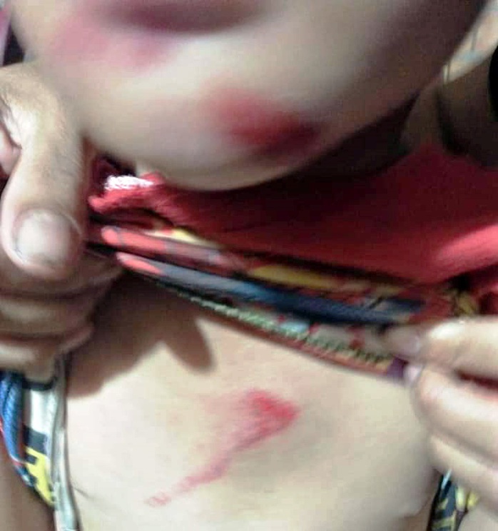 Một cháu bé 6 tuổi nghi bị chính mẹ ruột đánh dã man - Ảnh 1.