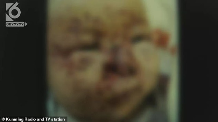 Bé 3 tháng tuổi bị chuột cắn nát mặt, đứt mũi - Ảnh 1.