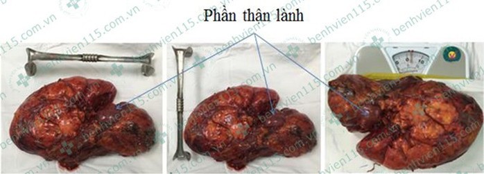 Lấy được loại u thận 3,5 kg thường gặp ở phái nữ - Ảnh 1.