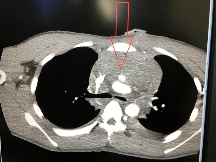 Kỳ diệu khi cứu sống 1 trường hợp thủng động mạch chủ cuống tim - Ảnh 1.
