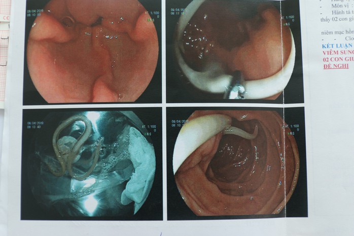 Tưởng đau dạ dày, hoá ra lươn chui vào ruột - Ảnh 2.