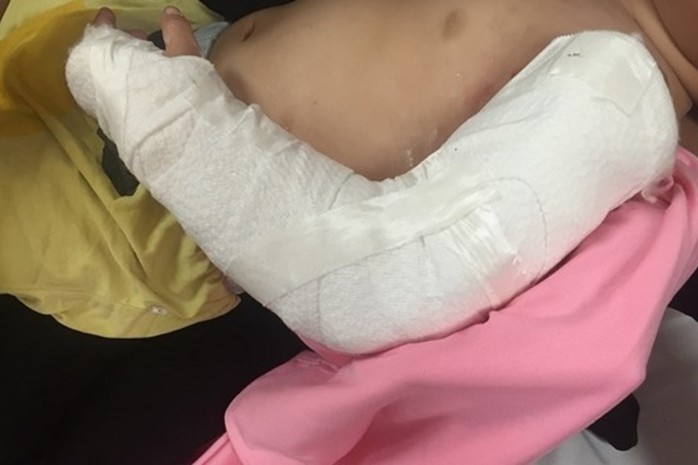 Chập chững ra đường, bé trai 19 tháng tuổi bị xe tải cán nát cánh tay - Ảnh 2. Chập chững ra đường, bé trai 19 tháng tuổi bị xe tải cán nát cánh tay - Ảnh 2.