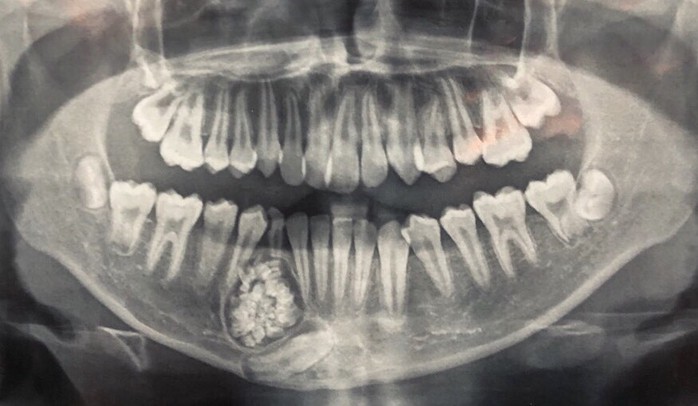 Hi hữu: Lấy gần 100 cái răng trong miệng một thiếu niên ở Khánh Hòa - Ảnh 1.