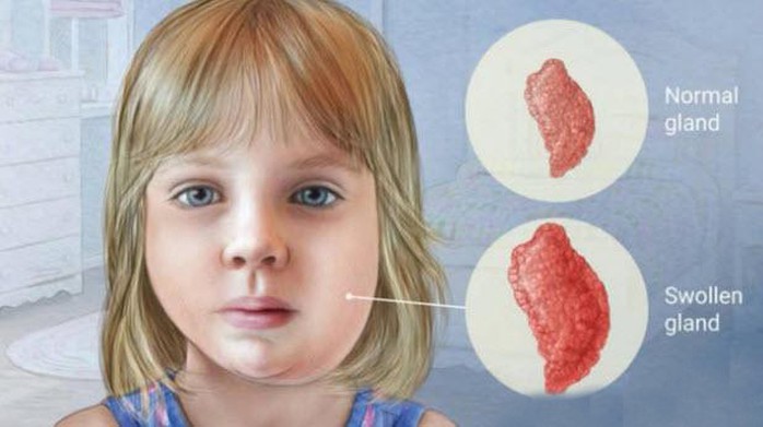 B&eacute; g&aacute;i mắc quai bị sau n&agrave;y c&oacute; v&ocirc; sinh? - Ảnh 1.