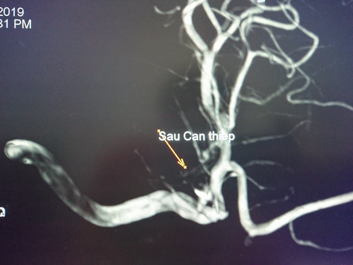 Thả 5 coil vào túi phình mạch máu não cứu nữ bệnh nhân đang sùi bọt mép - Ảnh 3.